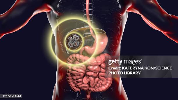 hydatid disease in liver, alveolar echinococcosis, illustrat - cyst stock illustrations