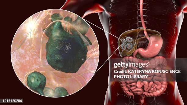 ilustraciones, imágenes clip art, dibujos animados e iconos de stock de hydatid disease in liver, alveolar echinococcosis, illustrat - tejido adiposo