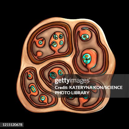 Echinococcus multilocularis hydatid cyst, illustration Echinococcus multilocularis hydatid cyst, illustration