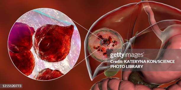 hydatid disease in liver, cystic echinococcosis, illustratio - dog tapeworm stock illustrations