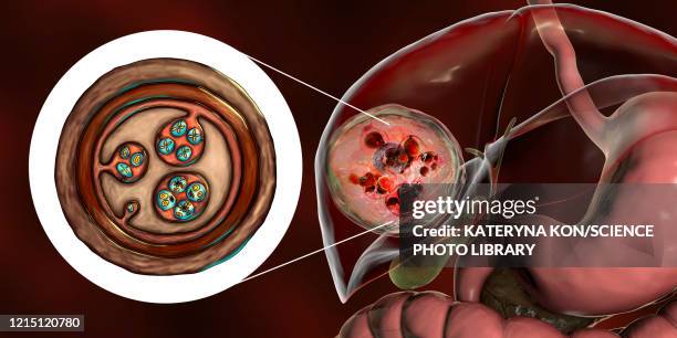 hydatid disease in liver, cystic echinococcosis, illustratio - dog tapeworm stock-grafiken, -clipart, -cartoons und -symbole