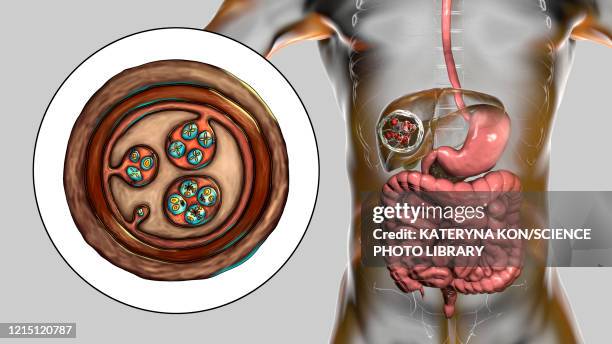 hydatid disease in liver, cystic echinococcosis, illustratio - dog tapeworm stock illustrations