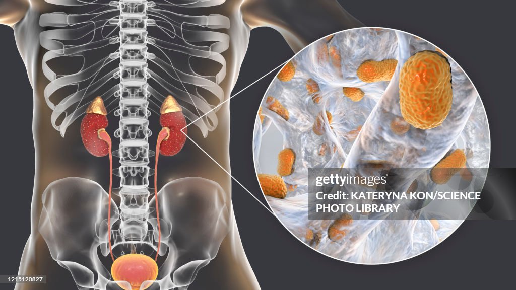 Acute pyelonephritis caused by Acinetobacter bacteria, illus