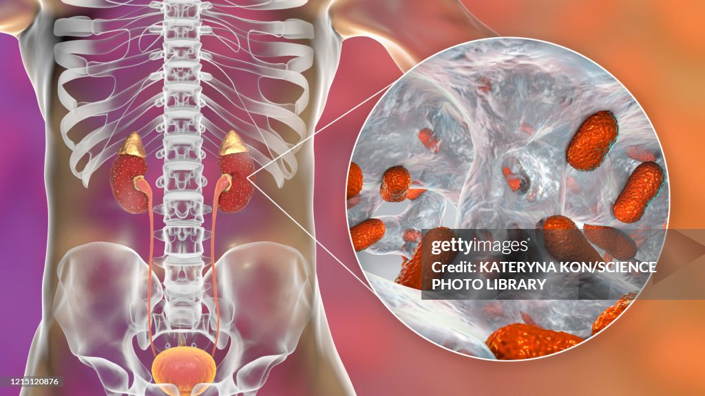 Acute pyelonephritis caused by Acinetobacter bacteria, illus
