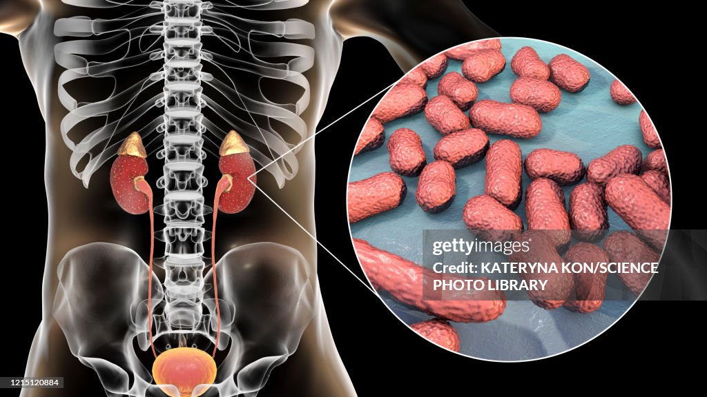 Acute pyelonephritis caused by Acinetobacter bacteria, illus