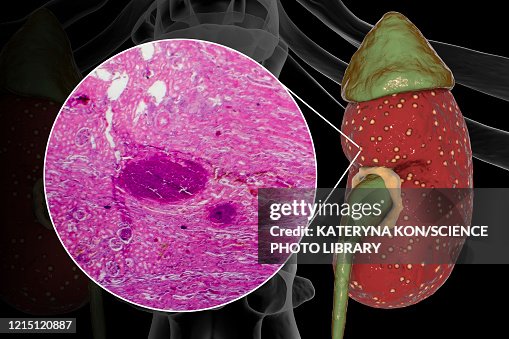Acute pyelonephritis, illustration and light micrograph Acute pyelonephritis, illustration and light micrograph