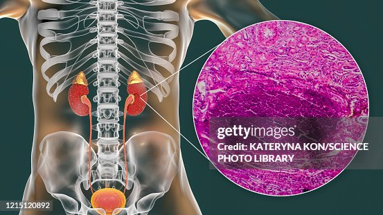 Acute pyelonephritis, illustration and light micrograph Acute pyelonephritis, illustration and light micrograph
