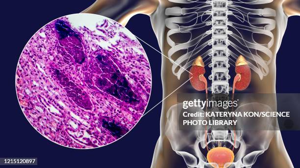 acute pyelonephritis, illustration and light micrograph - light micrograph stock illustrations