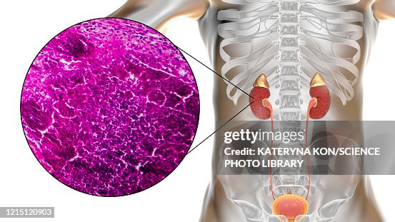 Acute pyelonephritis, illustration and light micrograph Acute pyelonephritis, illustration and light micrograph