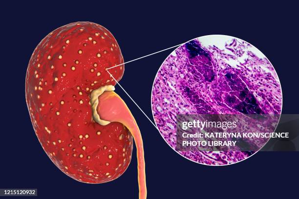 Acute Pyelonephritis Illustration And Light Micrograph High-Res Vector ...