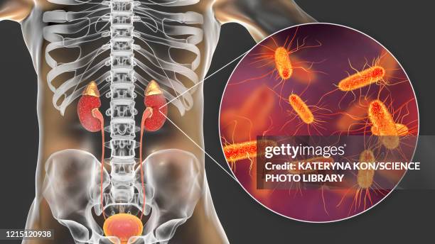 acute pyelonephritis caused by e coli, illustration - escherichia coli stock-grafiken, -clipart, -cartoons und -symbole