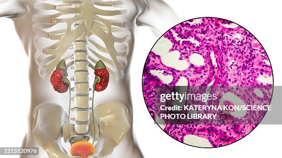 Chronic pyelonephritis, illustration and light micrograph Chronic pyelonephritis, illustration and light micrograph