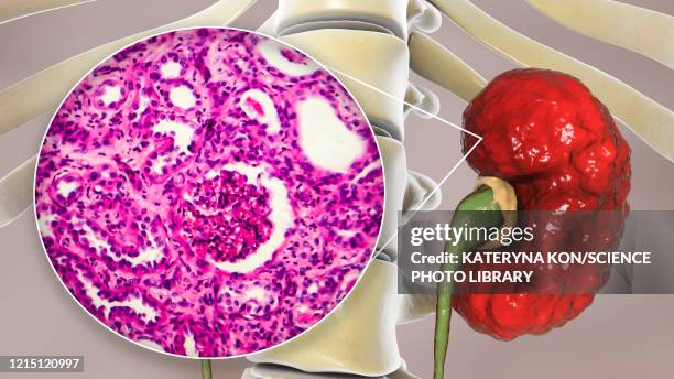 chronic pyelonephritis, illustration and light micrograph - light micrograph stock illustrations
