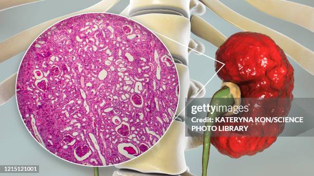 stockillustraties, clipart, cartoons en iconen met chronic pyelonephritis, illustration and light micrograph - abces