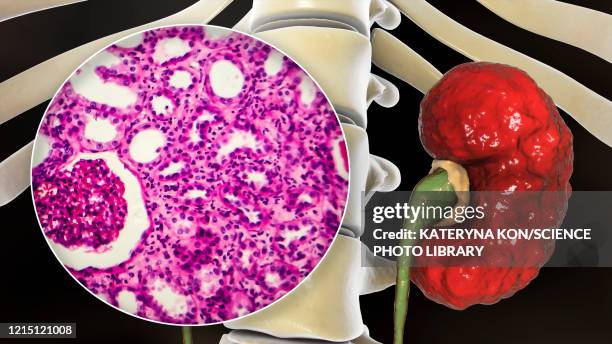 chronic pyelonephritis, illustration and light micrograph - light micrograph stock illustrations