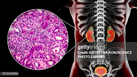 Chronic pyelonephritis, illustration and light micrograph Chronic pyelonephritis, illustration and light micrograph