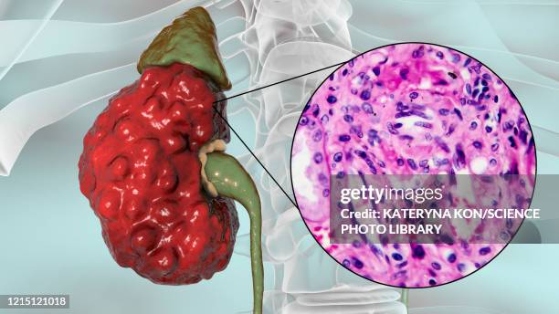 stockillustraties, clipart, cartoons en iconen met chronic pyelonephritis, illustration and light micrograph - abces