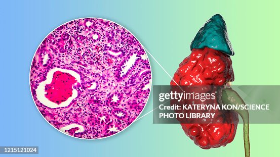 Chronic pyelonephritis, illustration and light micrograph Chronic pyelonephritis, illustration and light micrograph
