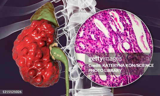 Chronic pyelonephritis, illustration and light micrograph Chronic pyelonephritis, illustration and light micrograph