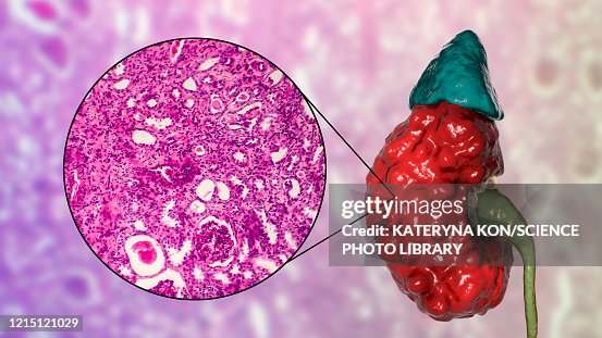 Chronic pyelonephritis, illustration and light micrograph Chronic pyelonephritis, illustration and light micrograph