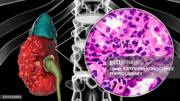 chronic pyelonephritis, illustration and light micrograph - light micrograph stock illustrations