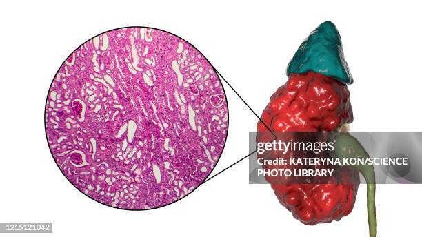 chronic pyelonephritis, illustration and light micrograph - kidney micrograph stock illustrations