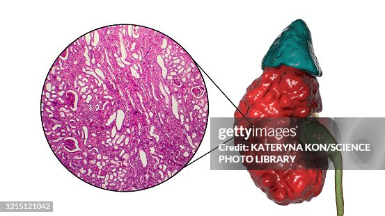 Chronic pyelonephritis, illustration and light micrograph Chronic pyelonephritis, illustration and light micrograph