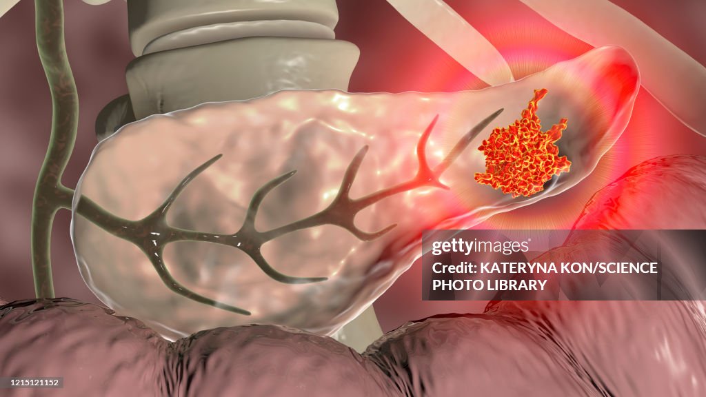 Pancreatic cancer, illustration