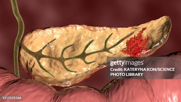 pancreatic cancer, illustration - pancreatic cancer stock illustrations