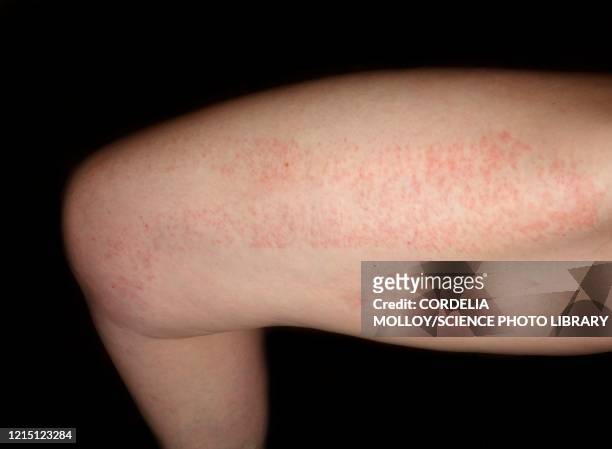 allergic dermatitis from therapeutic tape on the thigh - angry woman red stock pictures, royalty-free photos & images