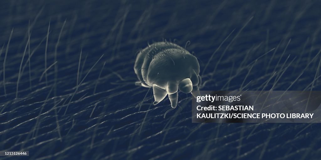 Scabies mite on human skin, illustration
