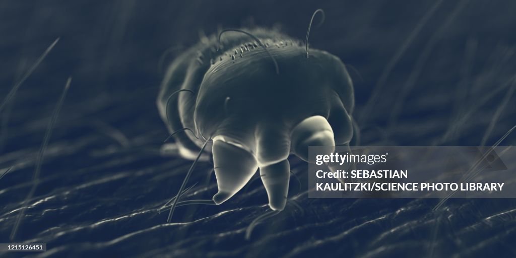 Scabies mite on human skin, illustration