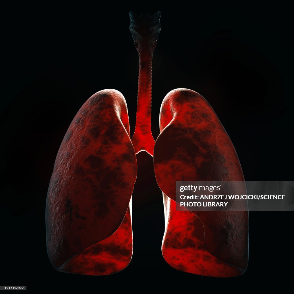 Lung infection, illustration