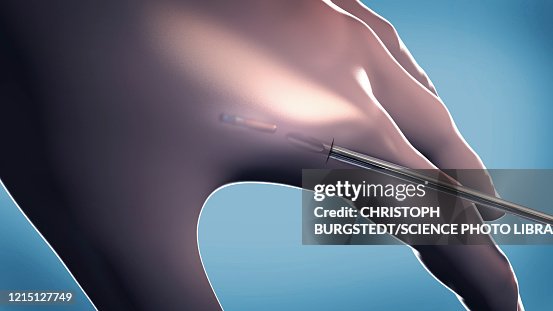 Microchip implanted in human hand, illustration Microchip implanted in human hand, illustration