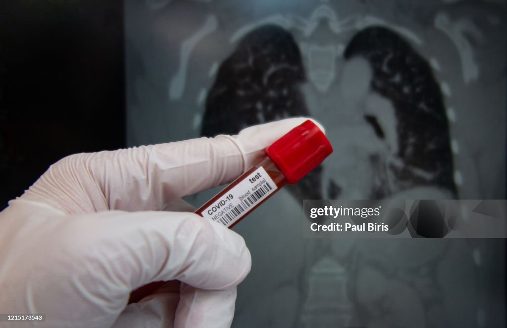 Doctor holding a blood sample for Ddtection of the pathogen coronavirus and analysing computer tomograpy image