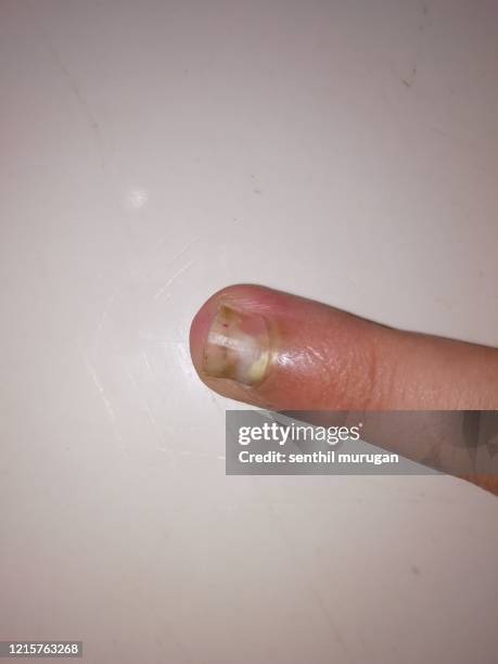 toenail fungus (tinea unguium) infection in the finger - tinea foto e immagini stock