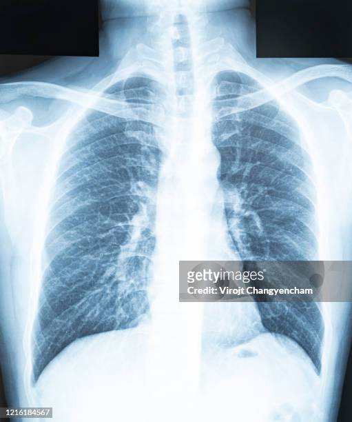 chest x-ray of a patient"u2019s lungs and respiratory tract - lunge krank stock-fotos und bilder