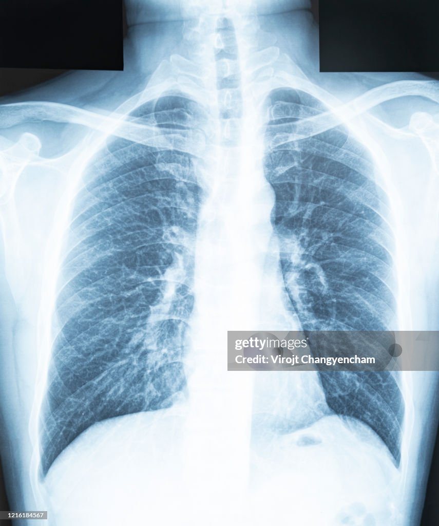 Chest x-ray of a patient"u2019s lungs and respiratory tract