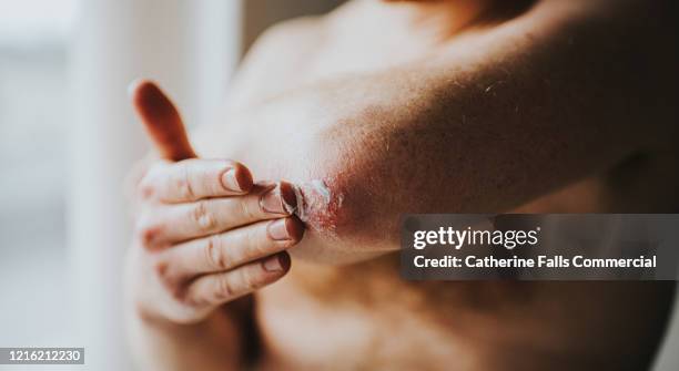 dry skin on elbows - mann ellbogen stock-fotos und bilder