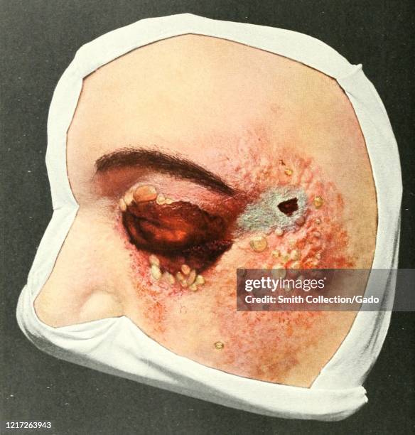 Illustration from the book "Atlas of Clinical Surgery" by Philipp Bockenheimer, featuring an eye and temple region of the face affected by anthrax,...