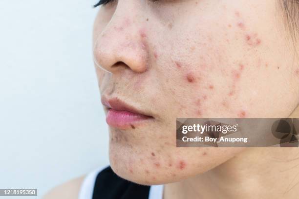 close up of woman face has variety problems on her skin (such as acne, pimple, pores and melasma etc). - hautfleck stock-fotos und bilder