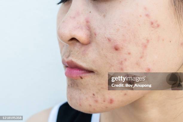 close up of woman face has variety problems on her skin (such as acne, pimple, pores and melasma etc). - acnes stockfoto's en -beelden