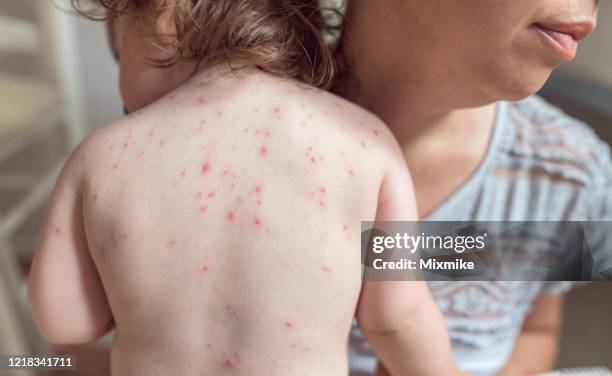 baby-mädchen mit varicella zoster virus infiziert - chickenpox stock-fotos und bilder