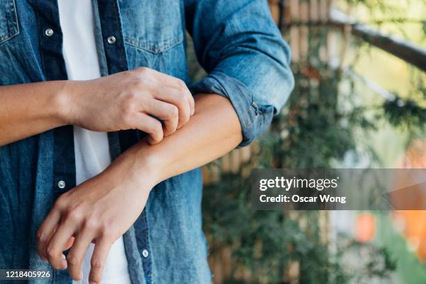 young man scratching forearm with fingers - allergy medicine stock pictures, royalty-free photos & images