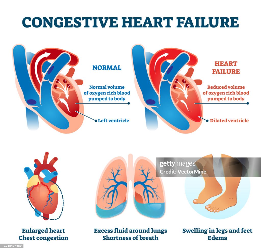 Medical Failure Congestive Heart Failure Vector Illustration Labeled Medical Compare ...