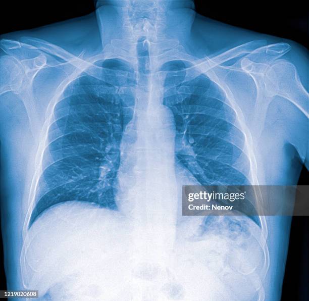 x-ray image of lung with pneumonia - équipement de radiologie photos et images de collection