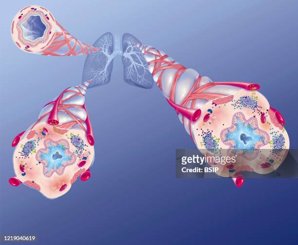 Asthma and its treatments to prevent airway obstruction. Representation of the lungs with the bronchial tree from which 3 zooms. In the upper left, a...
