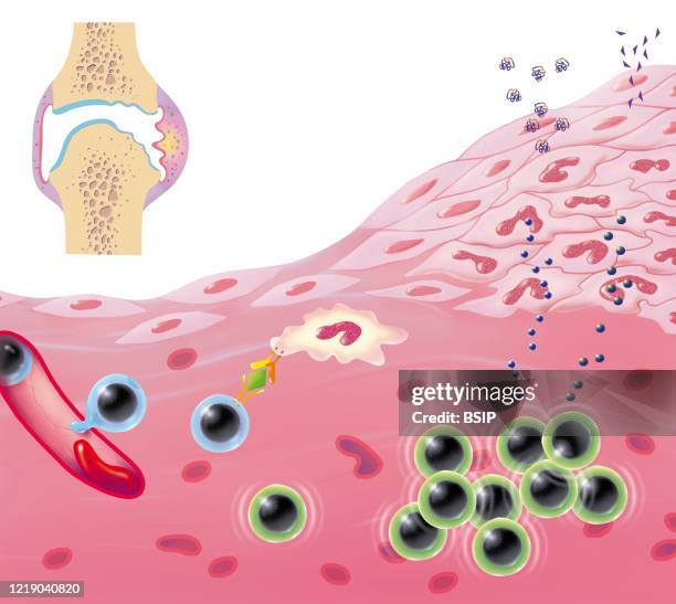 Joint destruction process, synovial hyperplasia, angiogenesis, edema, lymphocyte infiltration. In the upper left is a joint seen in section with...