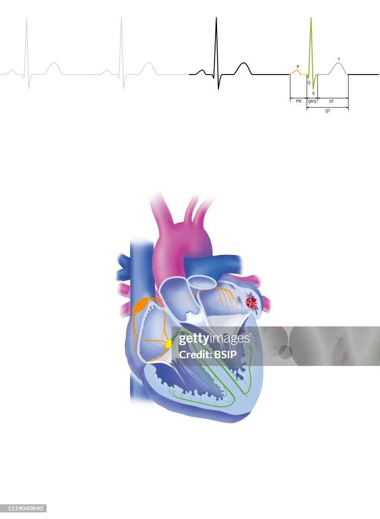 Atrial fibrillation