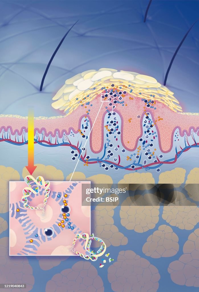 PSORIASIS